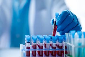 Pharmacist-Led Monitoring Boosts Resmetirom Lab Adherence, Cuts Discontinuation in MASH Study