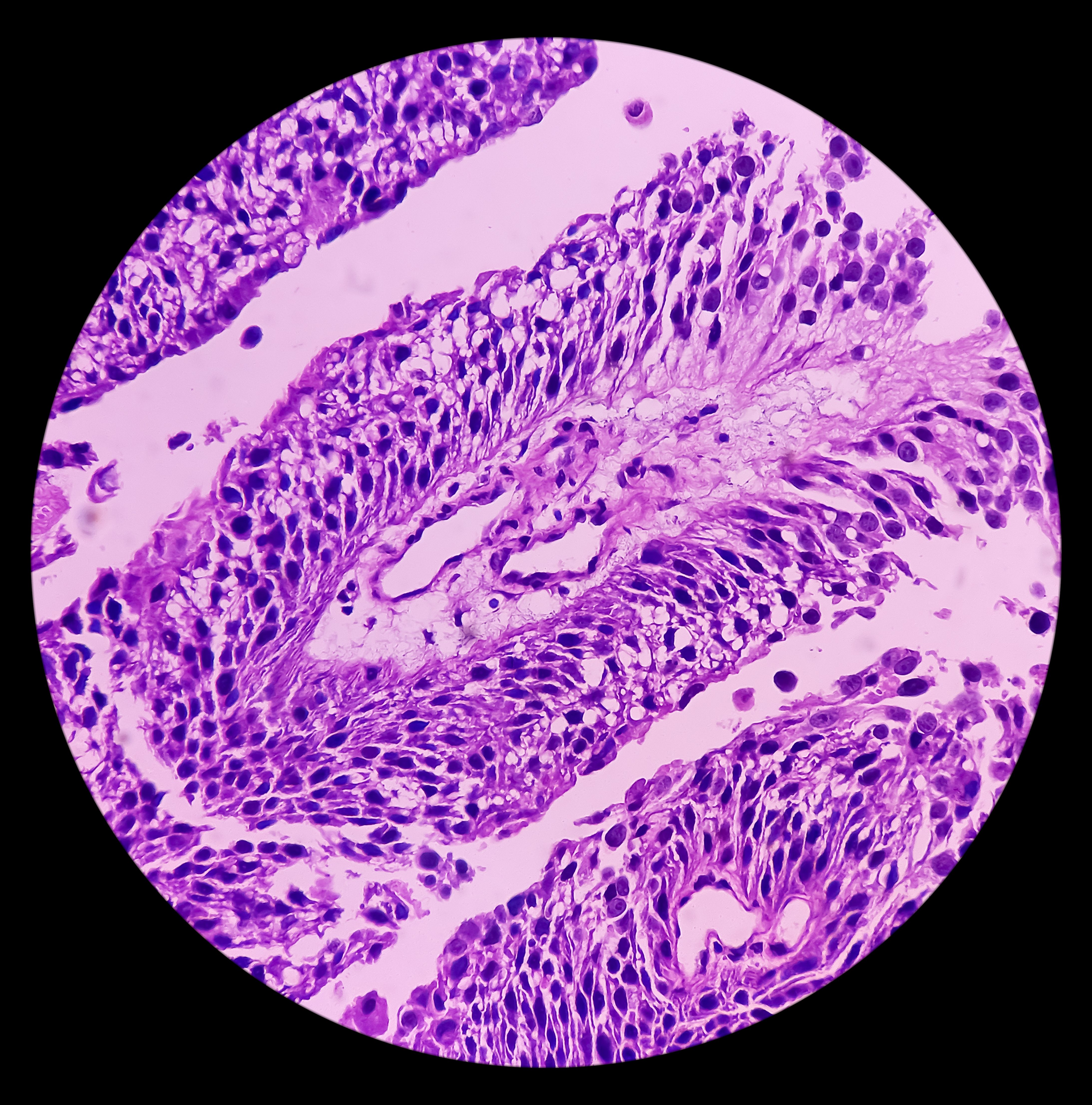 Image of bladder cancer -- Image credit: MdBabul | stock.adobe.com