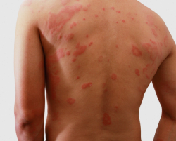 Case Study: The Pharmacist’s Role in Atopic Dermatitis Treatment
