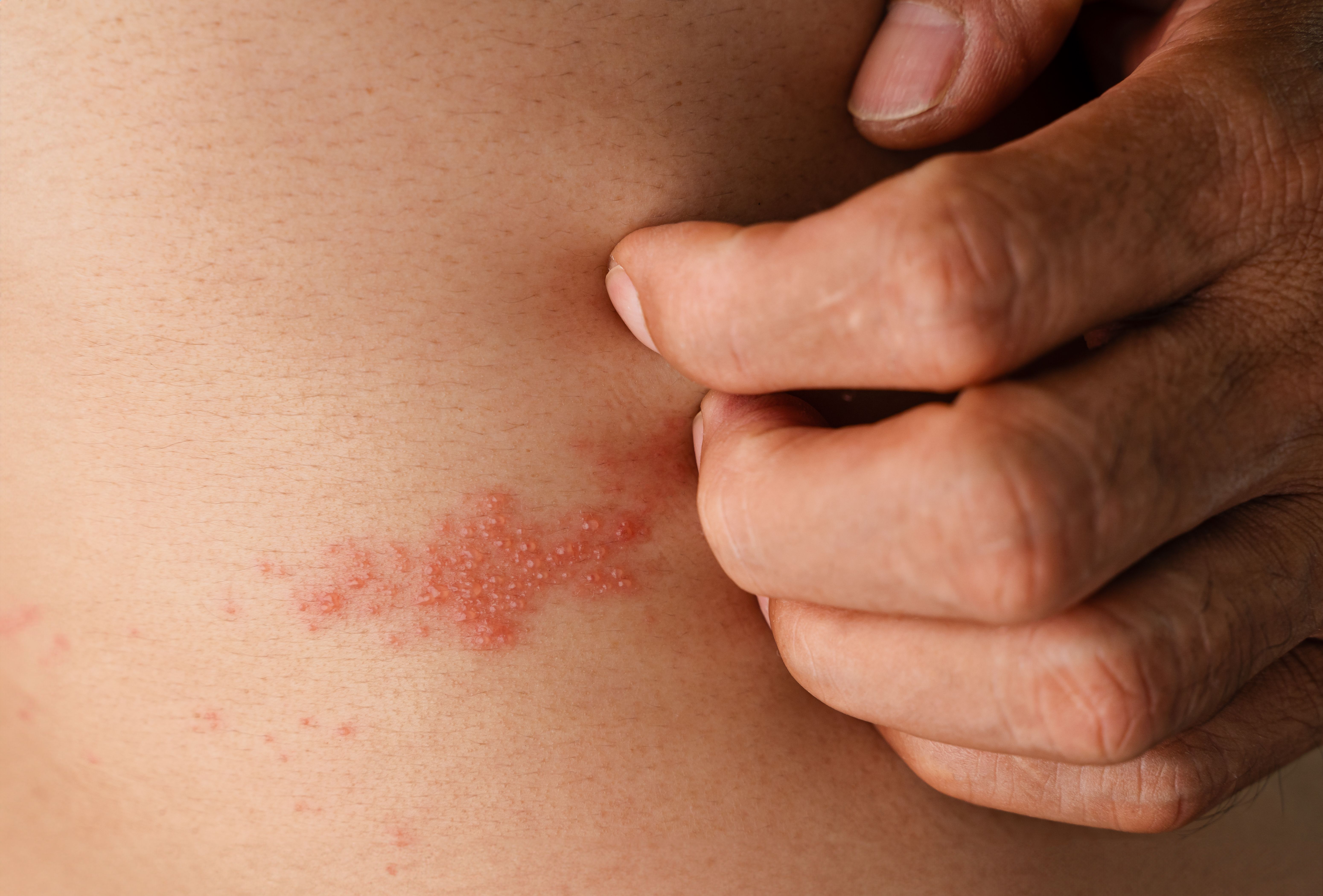 Man with shingles disease, skin infected with Herpes zoster, virus, Healthcare and medical - Image credit: Suriyawut | stock.adobe.com