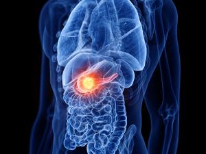 3d rendered medically accurate illustration of pancreas cancer | Image Credit: Sebastian Kaulitzki | stock.adobe.com