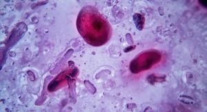 Sonrotoclax Plus Zanubrutinib Achieves Undetectable MRD Rates Above 90% in Frontline CLL/SLL