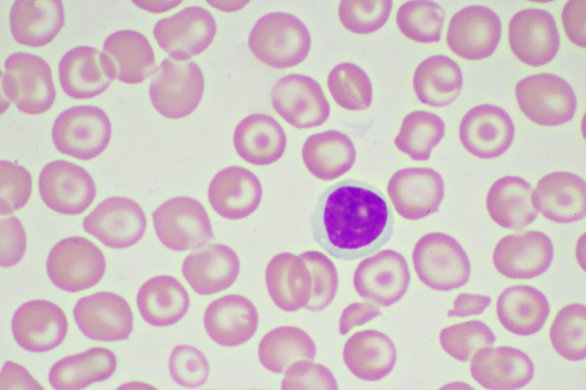 Target cells with abnormal red blood cells in blood smear, specimen from thalassemia patient, analyze by microscope 1000x