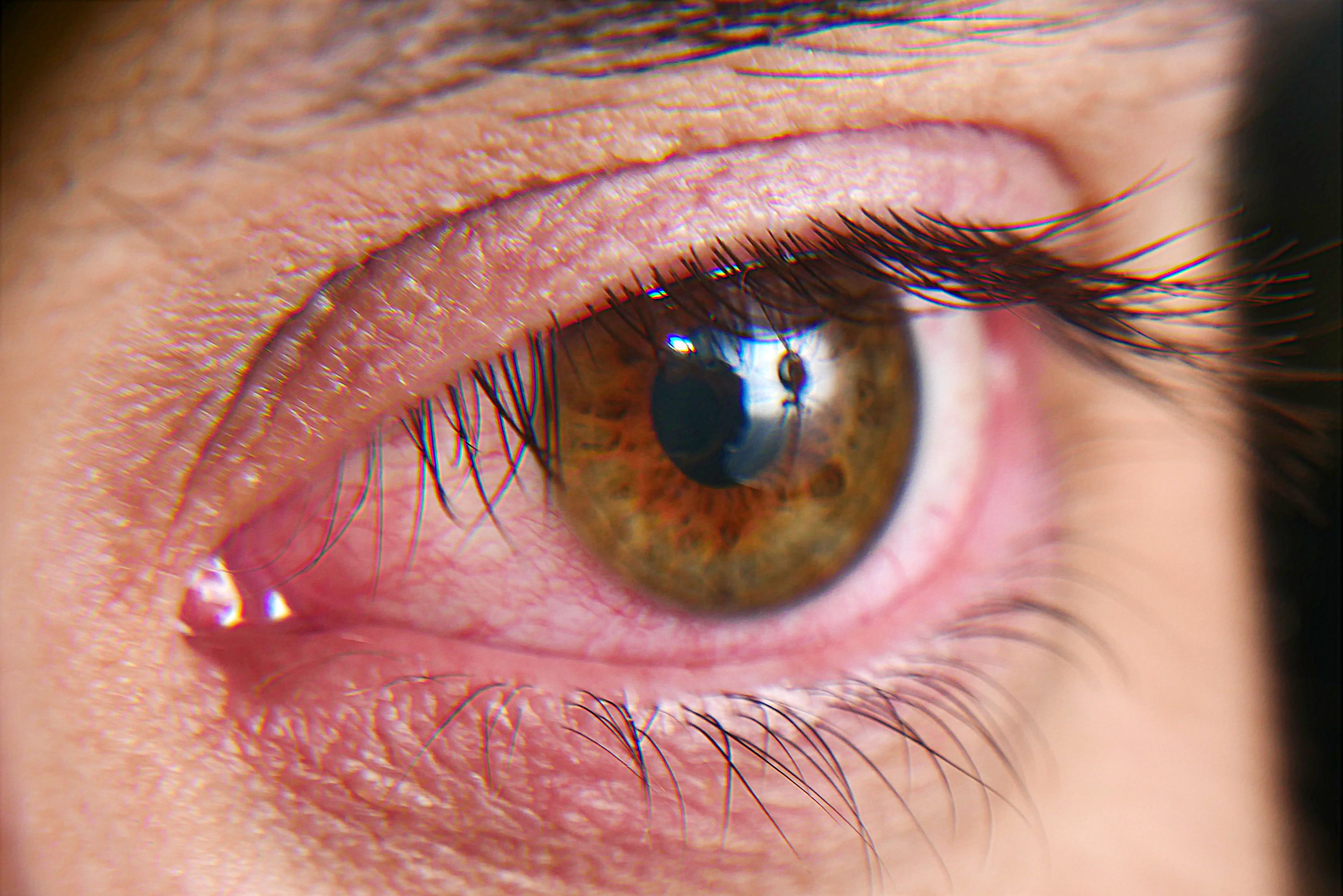 Red squirrel eyes, macro photo. Conjunctivitis, eye disease - Image credit: Kryuchka Yaroslav | stock.adobe