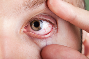 The Pharmacist Role in Customized Solutions for Patients with Dry Eye Disease
