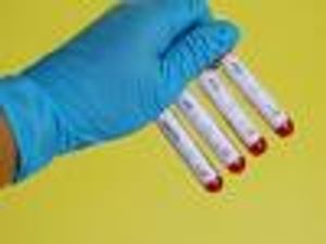 Increase in Hepatitis C Rate Found Among Some HIV-Positive Men