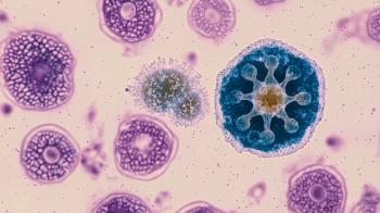 Microscopic View of Blood Cells Related to Aplastic Anemia
