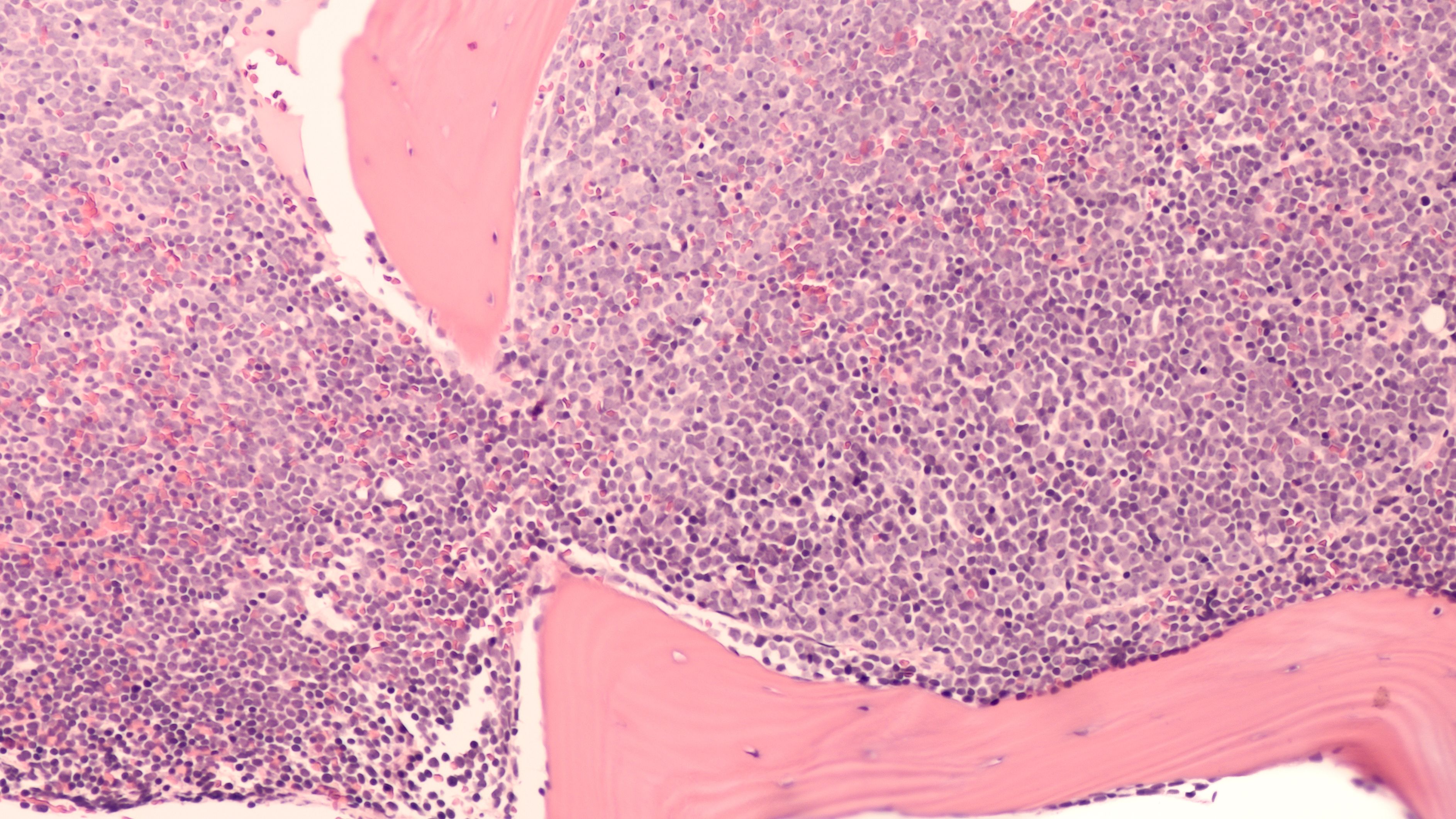 EHA 2025: GOLCA Plus Rituximab Shows Promise in R/R DLBCL
