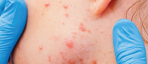 Management of Acne Vulgaris
