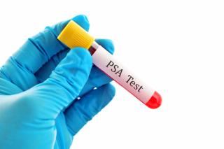 Expert Discusses the Current Screening Recommendations for Prostate Cancer