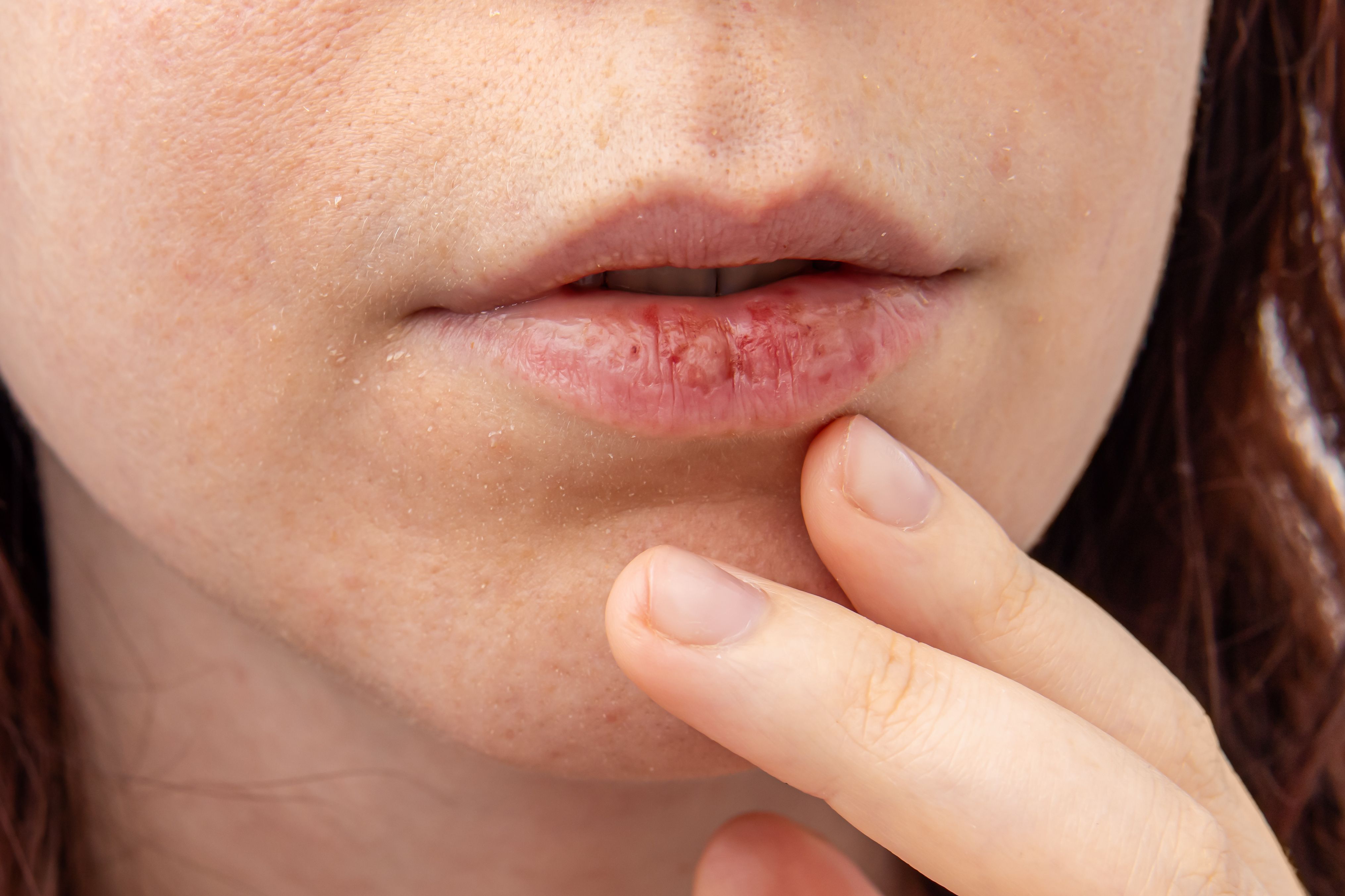 retatrutide dry mouth Mouth: Its Etiology, Symptoms, and Strategies for Management Dry Mouth Causes, Syptoms, Risk