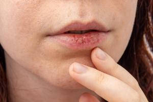 Woman with dry mouth -- Image credit: Svetlana | stock.adobe.com