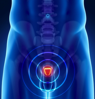 Pharmacist Medication Insights: Relugolix for Advanced Prostate Cancer