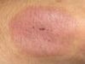 Vitamin D Deficiency Linked to Chronic Inflammatory Rheumatic Diseases