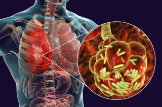 Pharmacist Medication Insights: Lefamulin (Xenleta) for Community-Acquired Bacterial Pneumonia