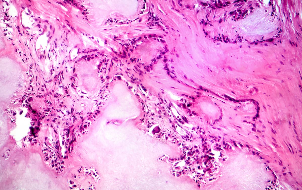 Gout tophus, photomicrograph showing amorphous, eosinophilic material with a foreign-body giant cell reaction and inflammation