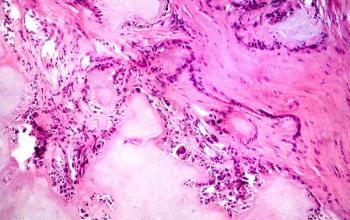 Gout tophus, photomicrograph showing amorphous, eosinophilic material with a foreign-body giant cell reaction and inflammation