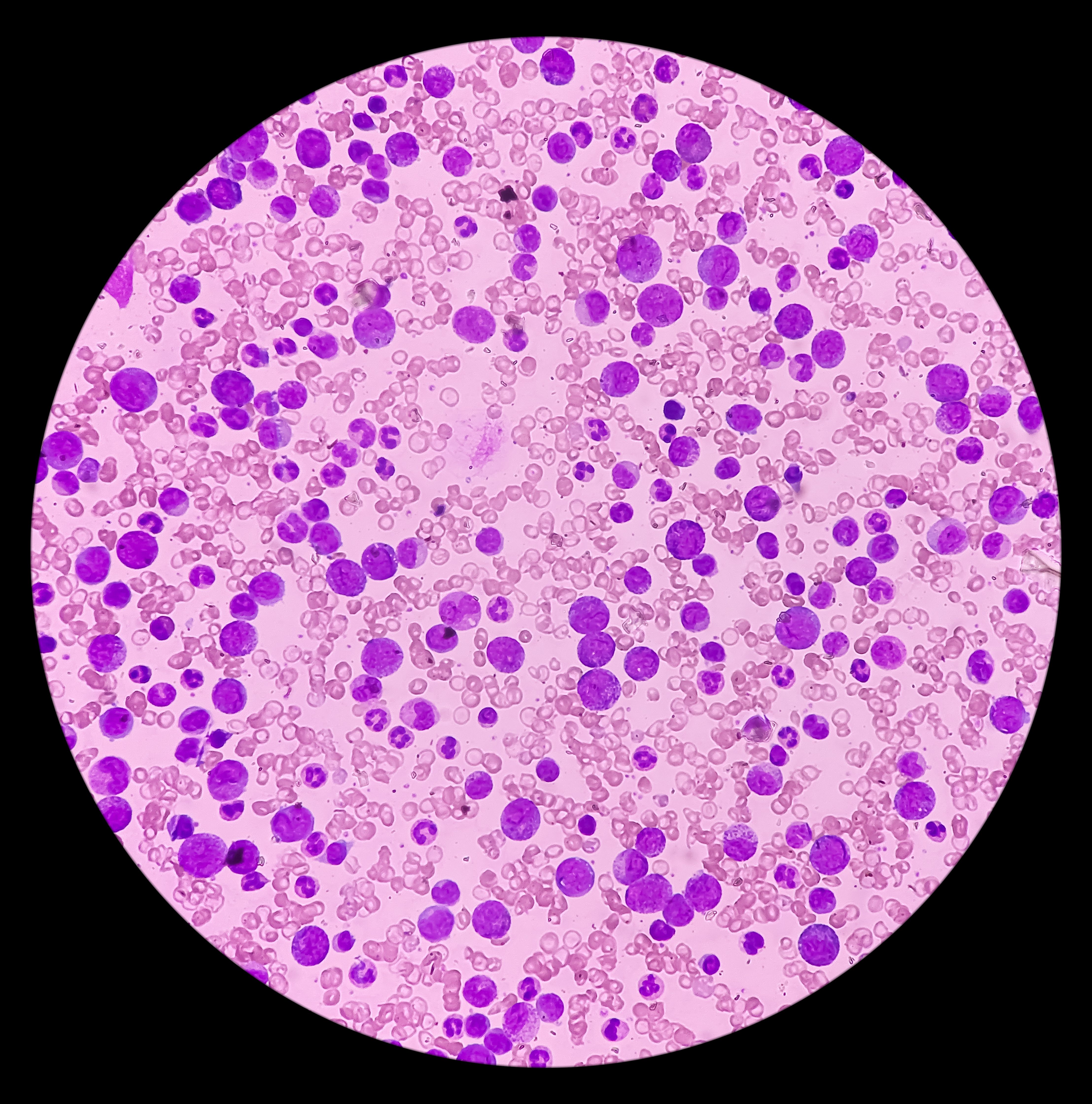 Chronic myeloid leukemia in chronic phase -- Image credit: MdBabul | stock.adobe.com