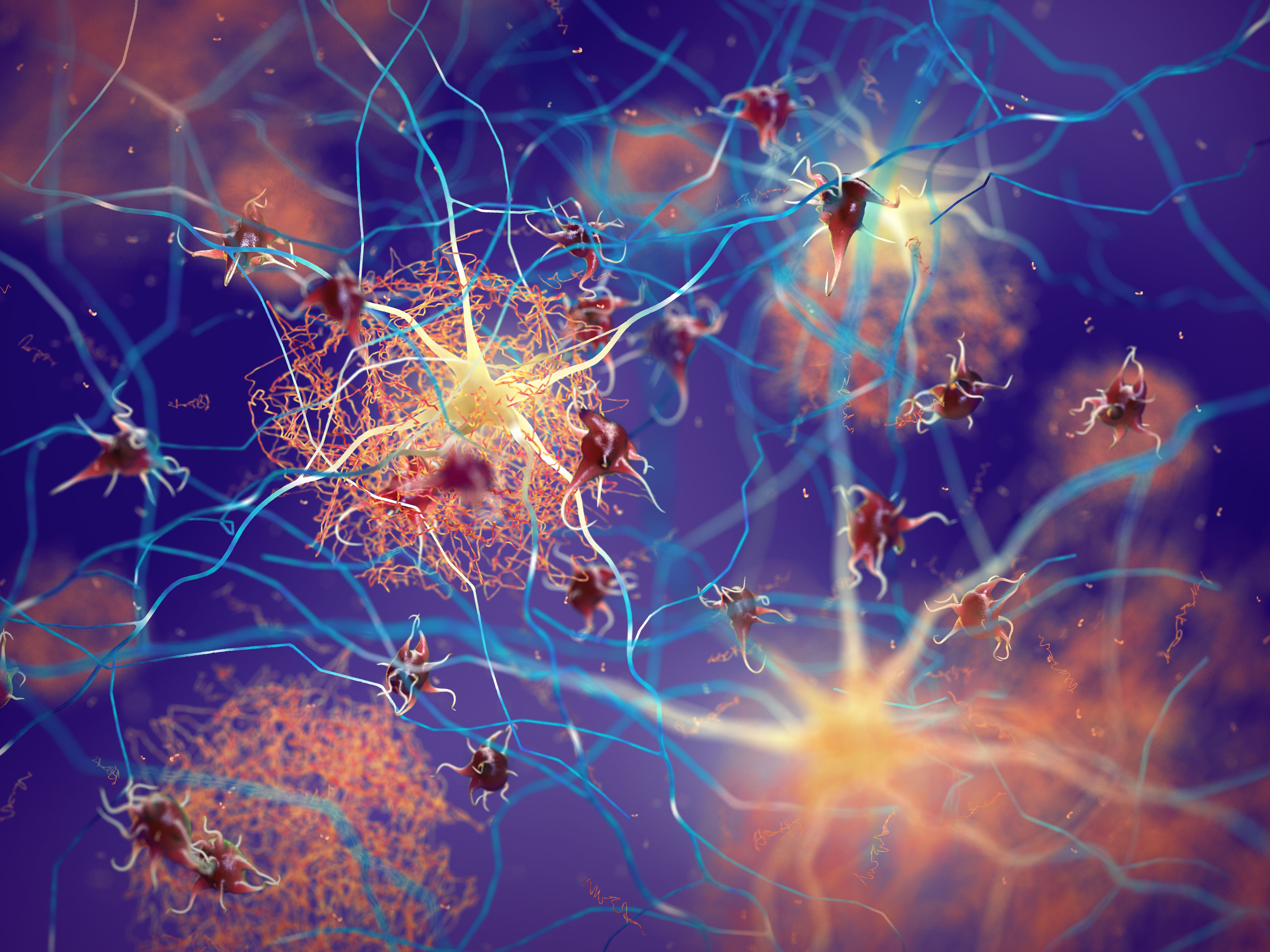 Tau pathology in patient with Alzheimer disease -- Image credit: nobeastsofierce | stock.adobe.com