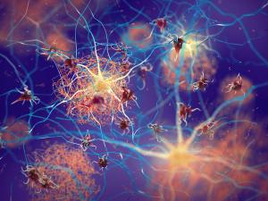 Tau pathology in patient with Alzheimer disease -- Image credit: nobeastsofierce | stock.adobe.com