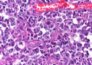 Oncology Overview: Treatment of Chronic Lymphocytic Leukemia with Ibrutinib, Venetoclax