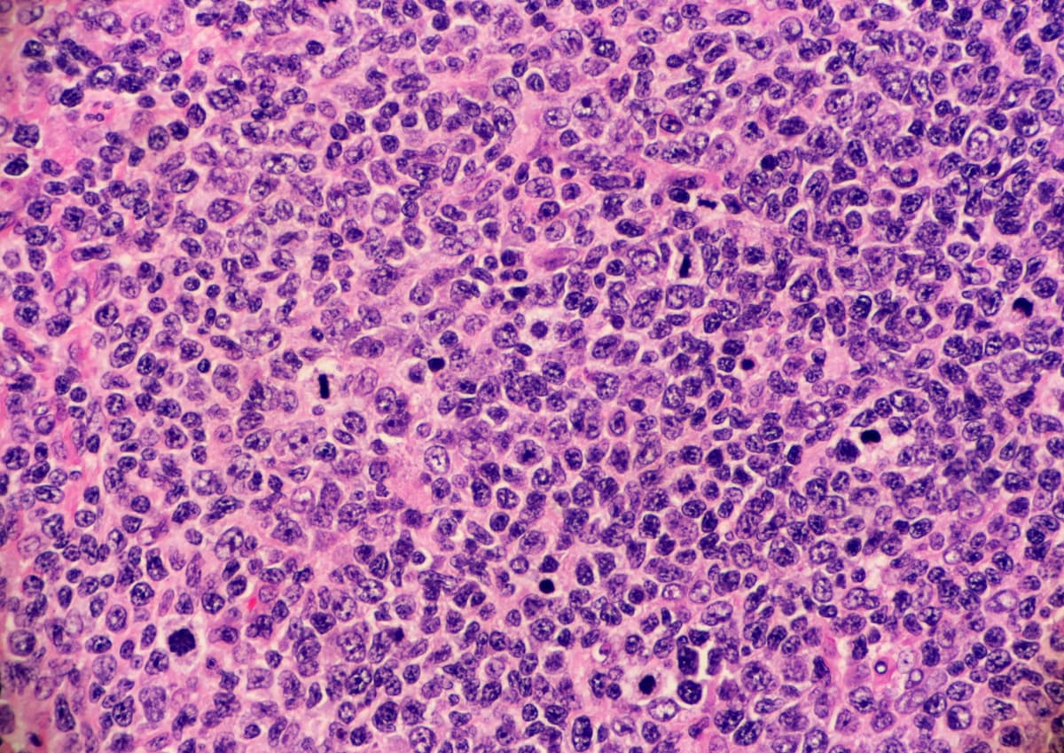 High grade follicular lymphoma with marginal zone differentiation. Multiple lymphocytes are undergoing mitosis. Microscopic view.