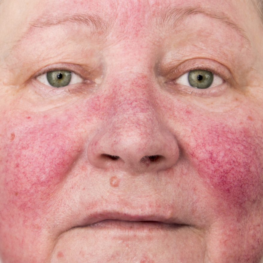 Minocycline Topical Foam Now Available for Rosacea in Pharmacies Nationwide