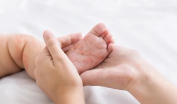 Mother holding baby's foot with measles spots | Image Credit: © rostock-studio - stock.adobe.com