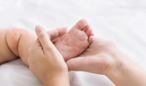 Mother holding baby's foot with measles spots | Image Credit: © rostock-studio - stock.adobe.com