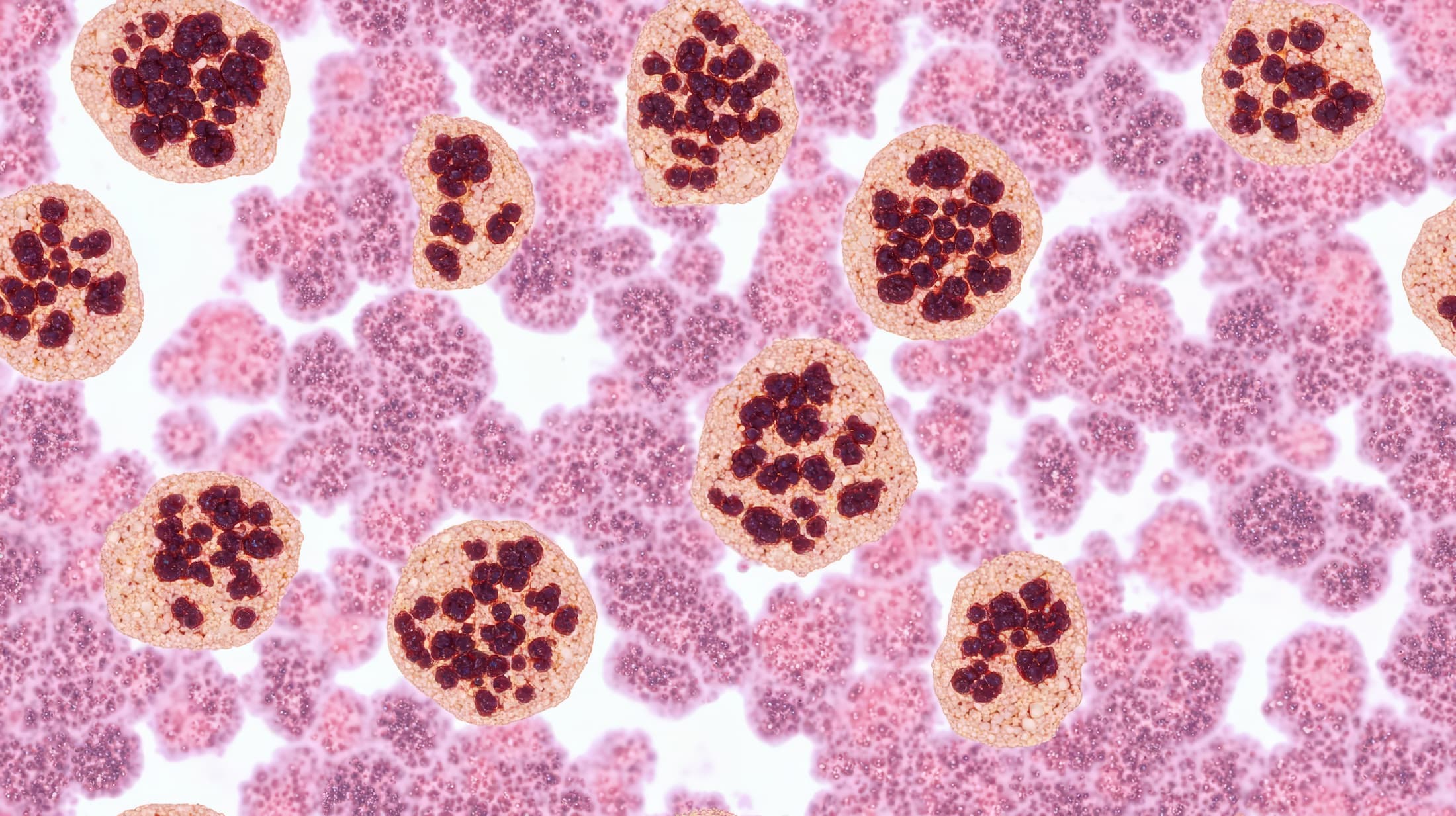 A staging bone marrow biopsy shows replacement of normal elements by diffuse large B-cell lymphoma, a type of non Hodgkin lymphoma, a malignancy (cancer) of lymphocytes, in this ca