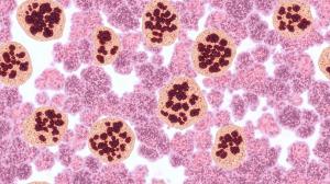 A staging bone marrow biopsy shows replacement of normal elements by diffuse large B-cell lymphoma, a type of non Hodgkin lymphoma, a malignancy (cancer) of lymphocytes, in this ca