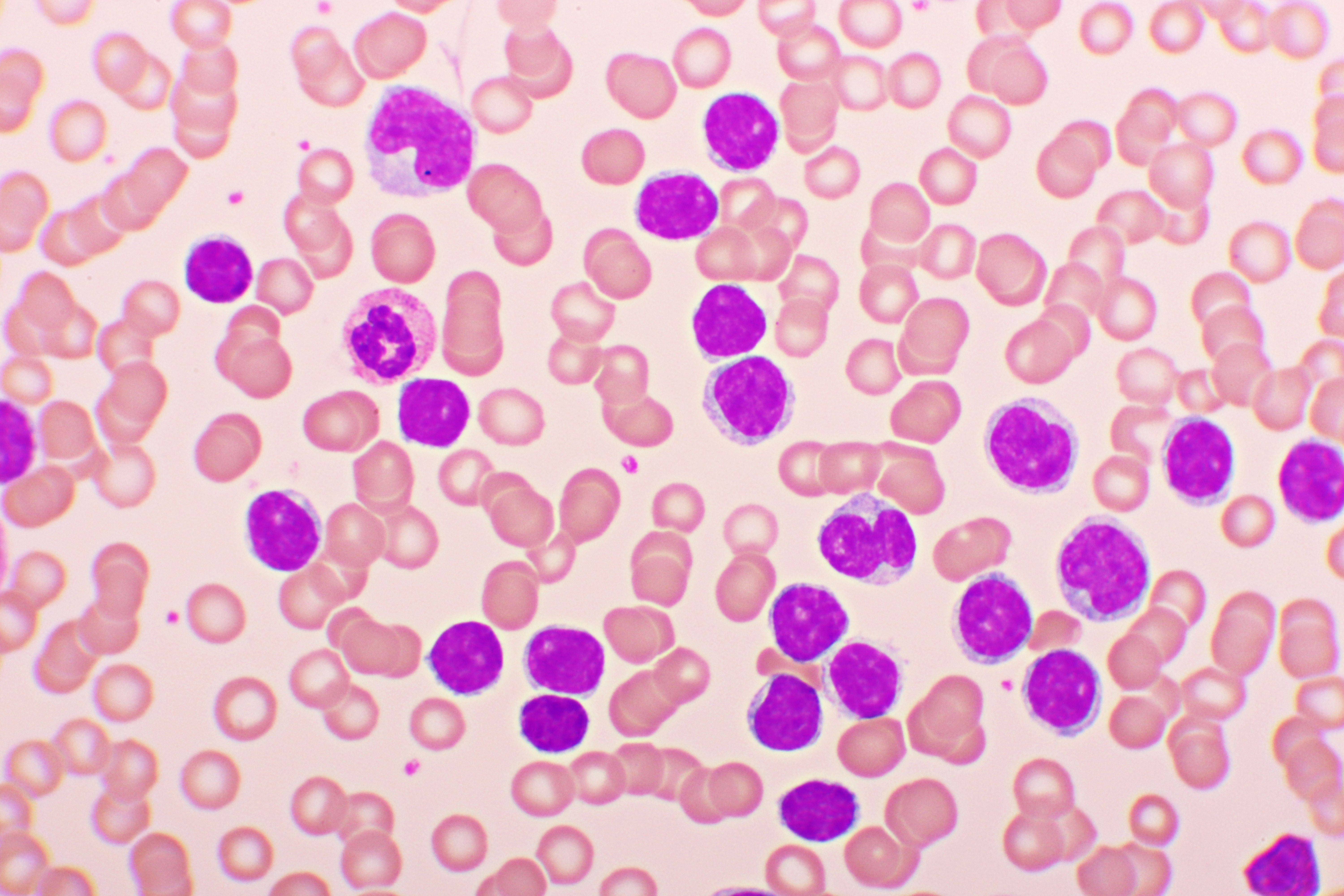 EHA 2025: No Added Toxicity Observed With Bleximenib Plus Venetoclax and Azacitidine in AML