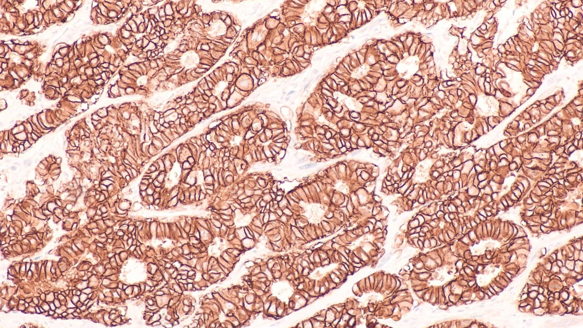 Photomicrograph of immunohistochemistry for HER2, showing positive cell membrane staining in this infiltrating ductal carcinoma.