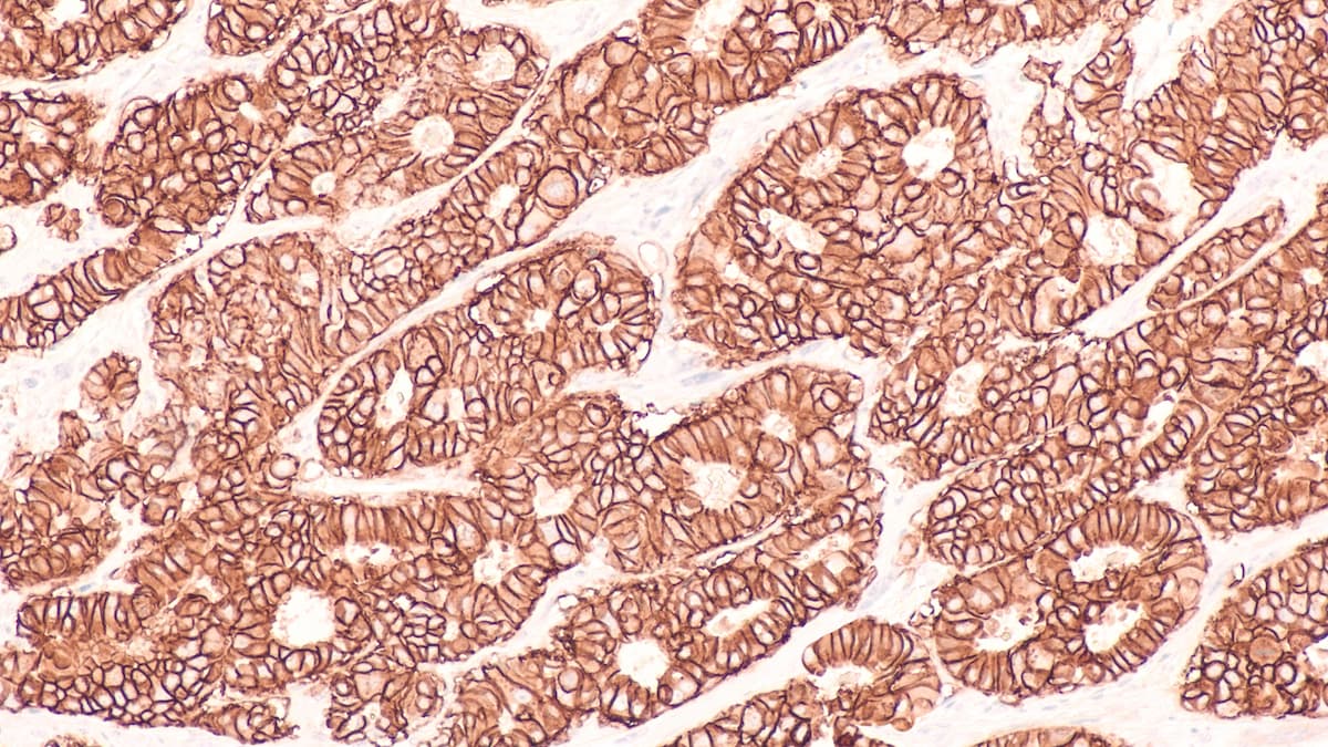 Photomicrograph of immunohistochemistry for HER2, showing positive cell membrane staining in this infiltrating ductal carcinoma. 