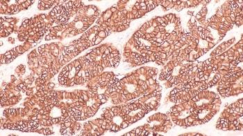 Photomicrograph of immunohistochemistry for HER2, showing positive cell membrane staining in this infiltrating ductal carcinoma.