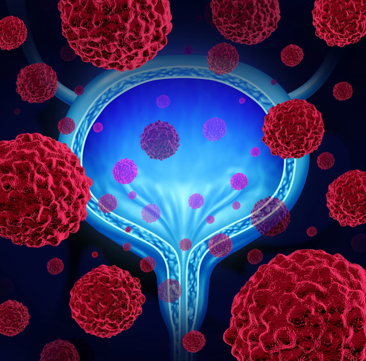 Bladder Cancer -- Image Credit: © freshidea - stock.adobe.com