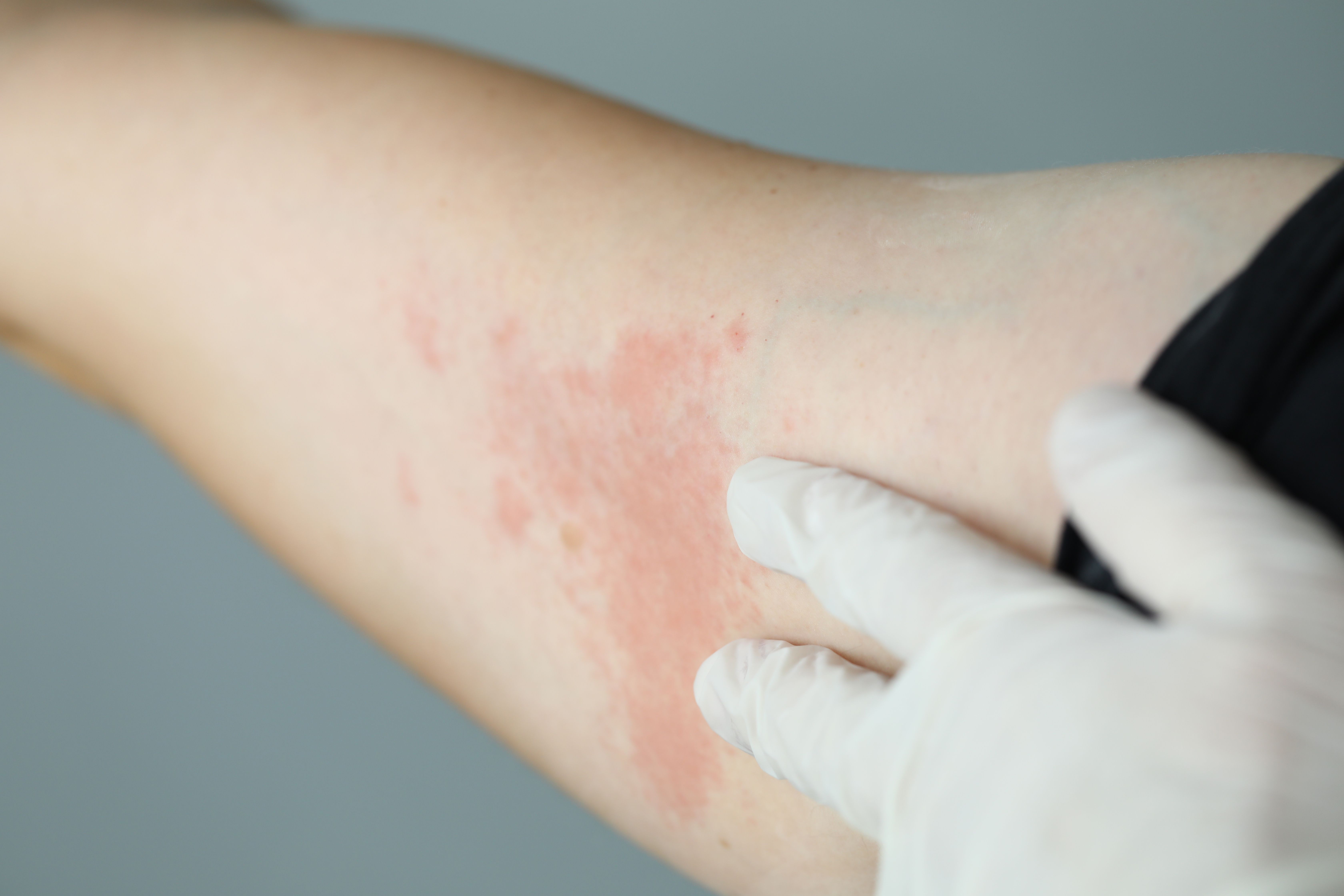 Patient-Centered Management of Dermatologic Toxicities in Oncology ...