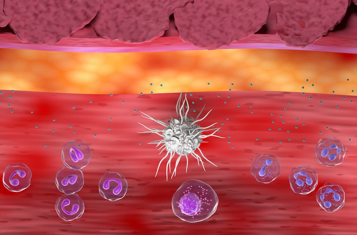 Inflammatory skin in Eczema, Atopic Dermatitis (AD) - top view 3d illustration