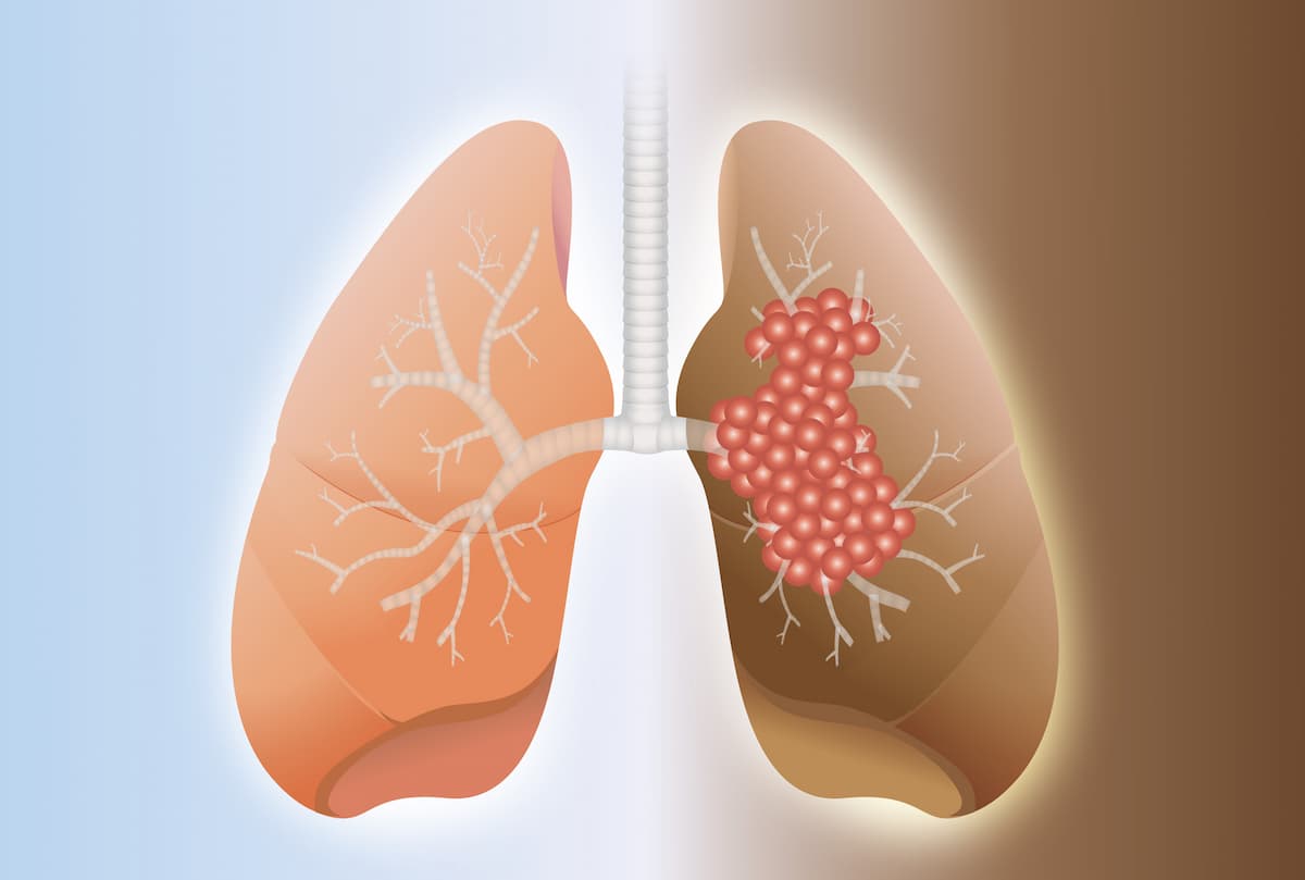 Comparative between healthy lung and cancer lung on difference background.