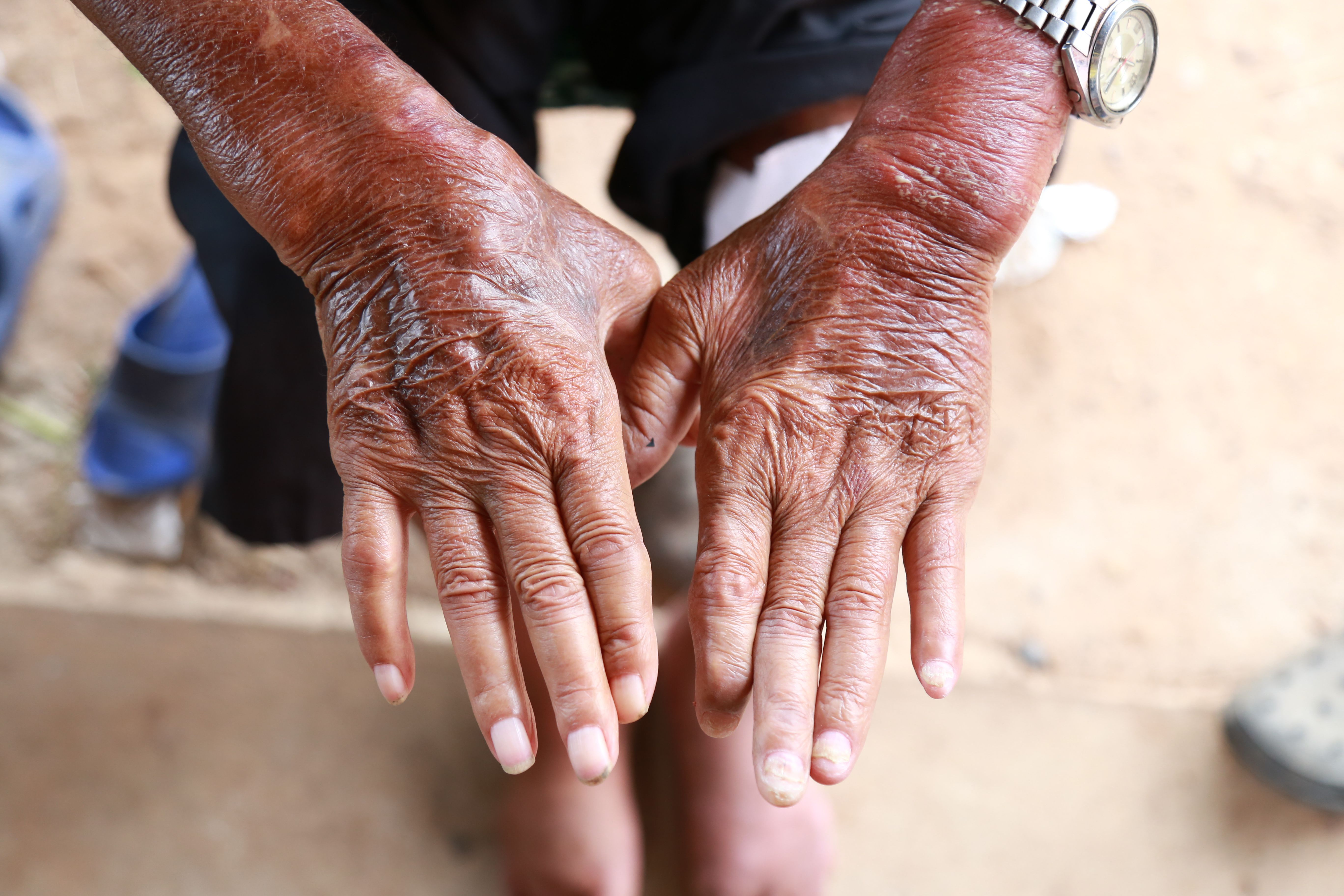 Skin disorder, pepper appearance from scleroderma, autoimmune disease male hand Skin disorder pepper appearance from vitiligo,scleroderma raynaud, medical concept autoimmune disease. Skin disorder - Image credit: Trsakaoe | stock.adobe.com