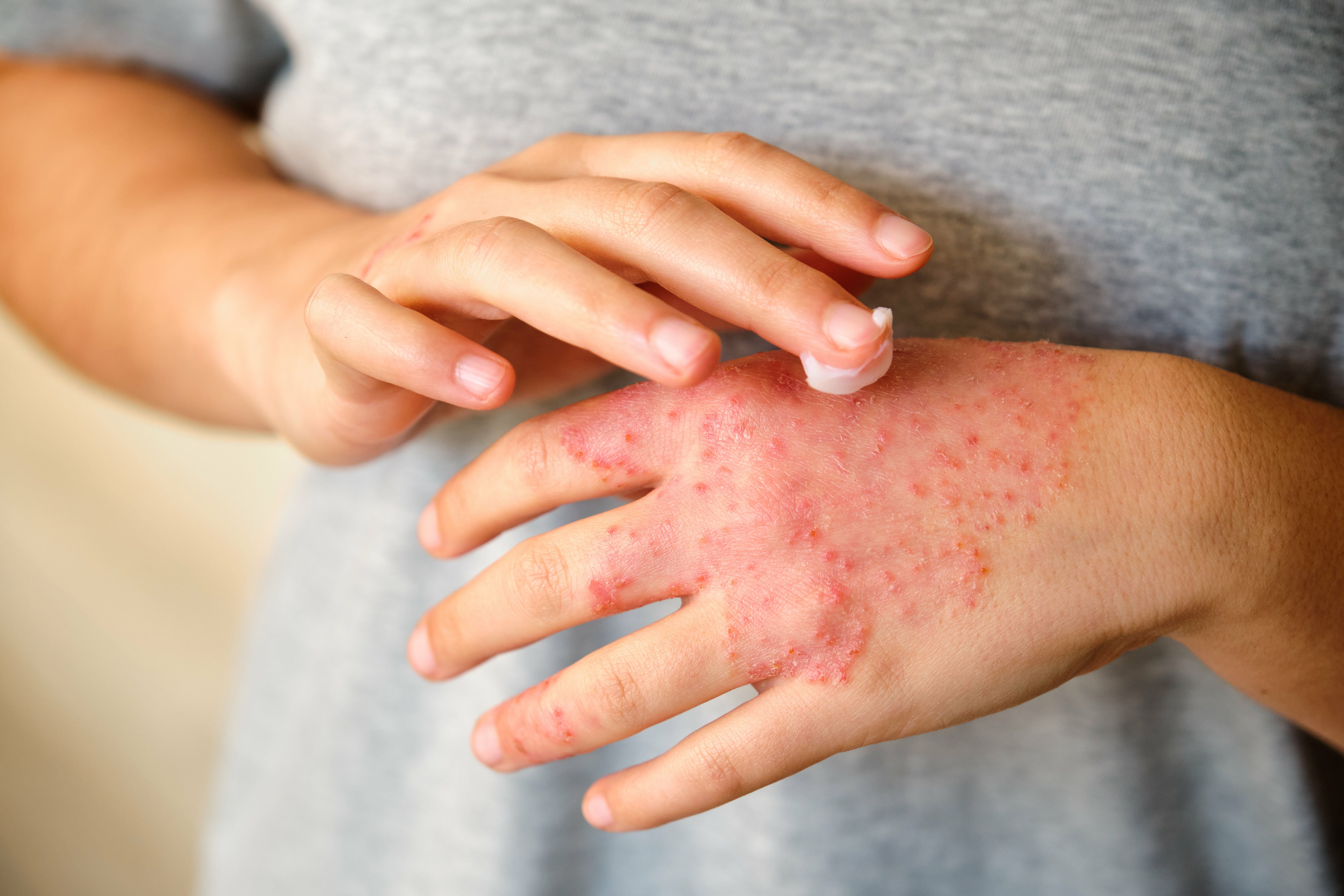 AAAAI: Twice-Daily Ruxolitinib Cream Improves Atopic Dermatitis Severity