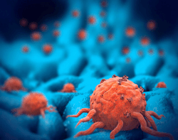 Researchers Tackle Limitations, Opportunities of CAR T Cells in Solid Tumors