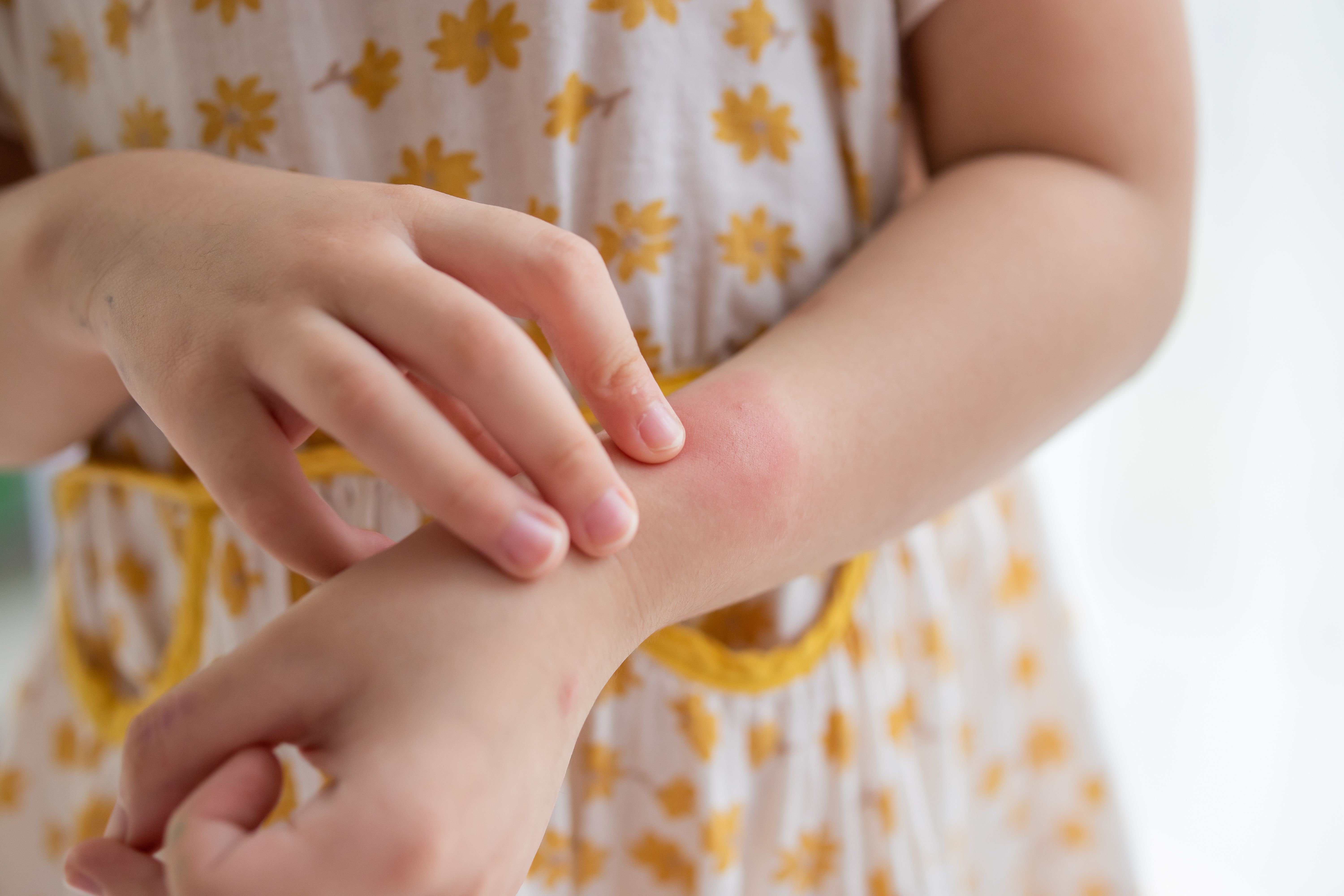 Young girl with psoriasis -- Image credit: Kwangmoozaa | stock.adobe.com