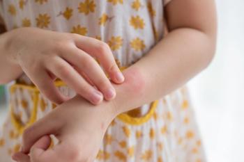 Young girl with psoriasis -- Image credit: Kwangmoozaa | stock.adobe.com