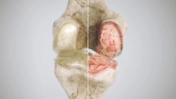 healthy knee and osteoarthritis knee in comparison - high degree of detail