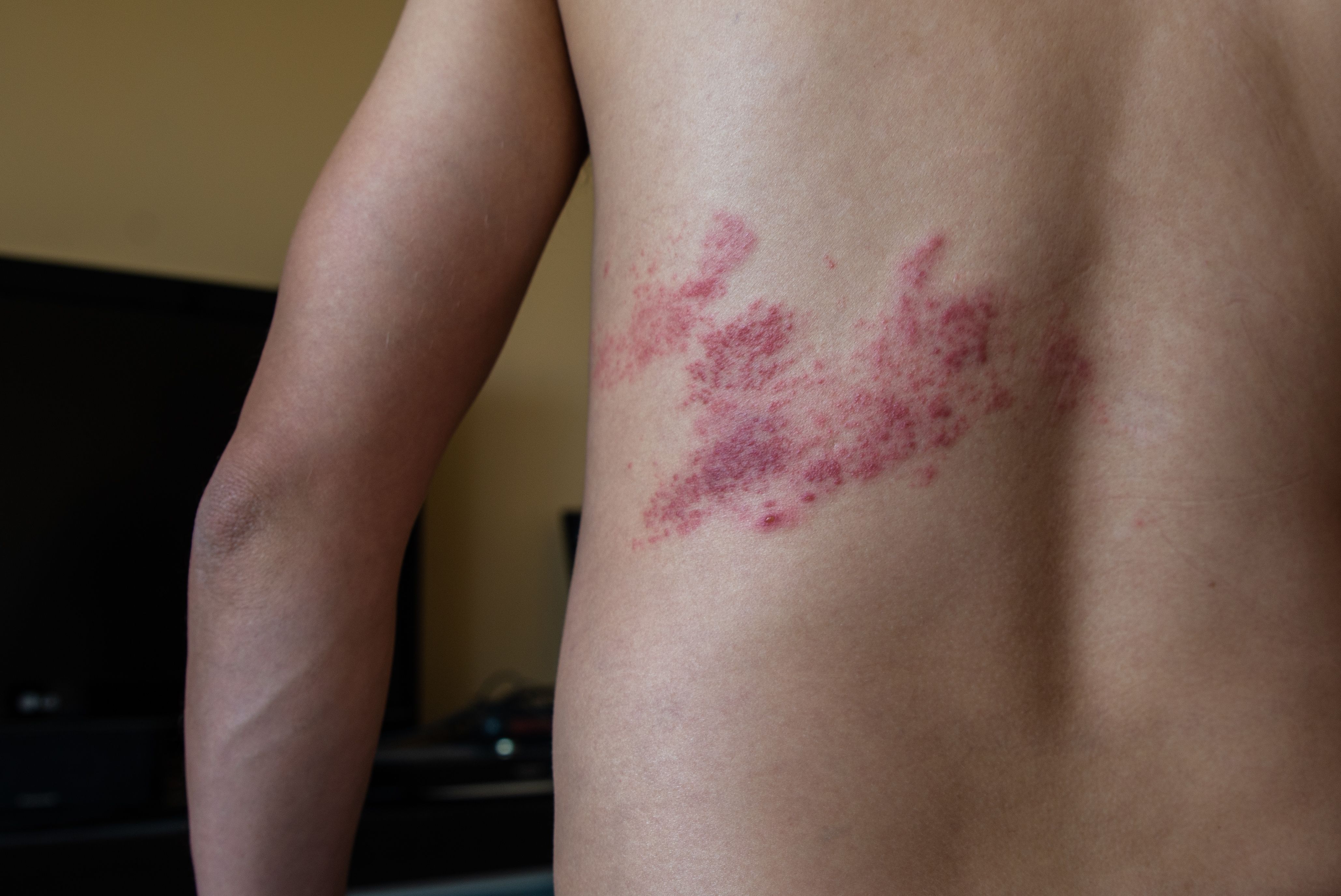 Although Rare, Shingles in Children Can Occur