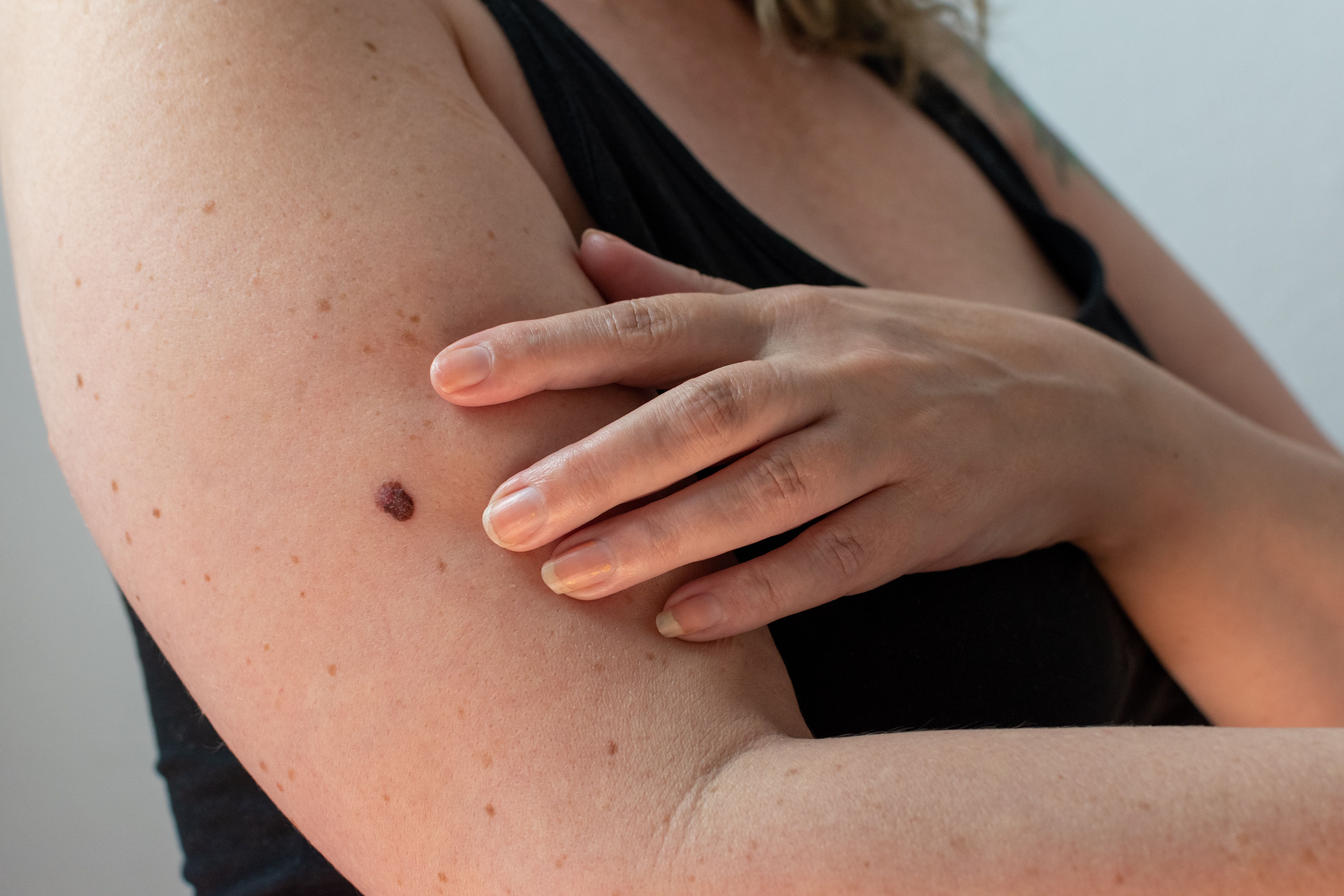 woman checking her skin for an abnormal mole for signs of melanoma skin cancer - Image credit: MW Photography | stock.adobe.com