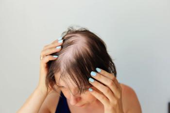 Bald head of a woman. Hair thinning after covid. Bald patches of total alopecia - Image credit: Nadya Kolobova | stock.adobe.com