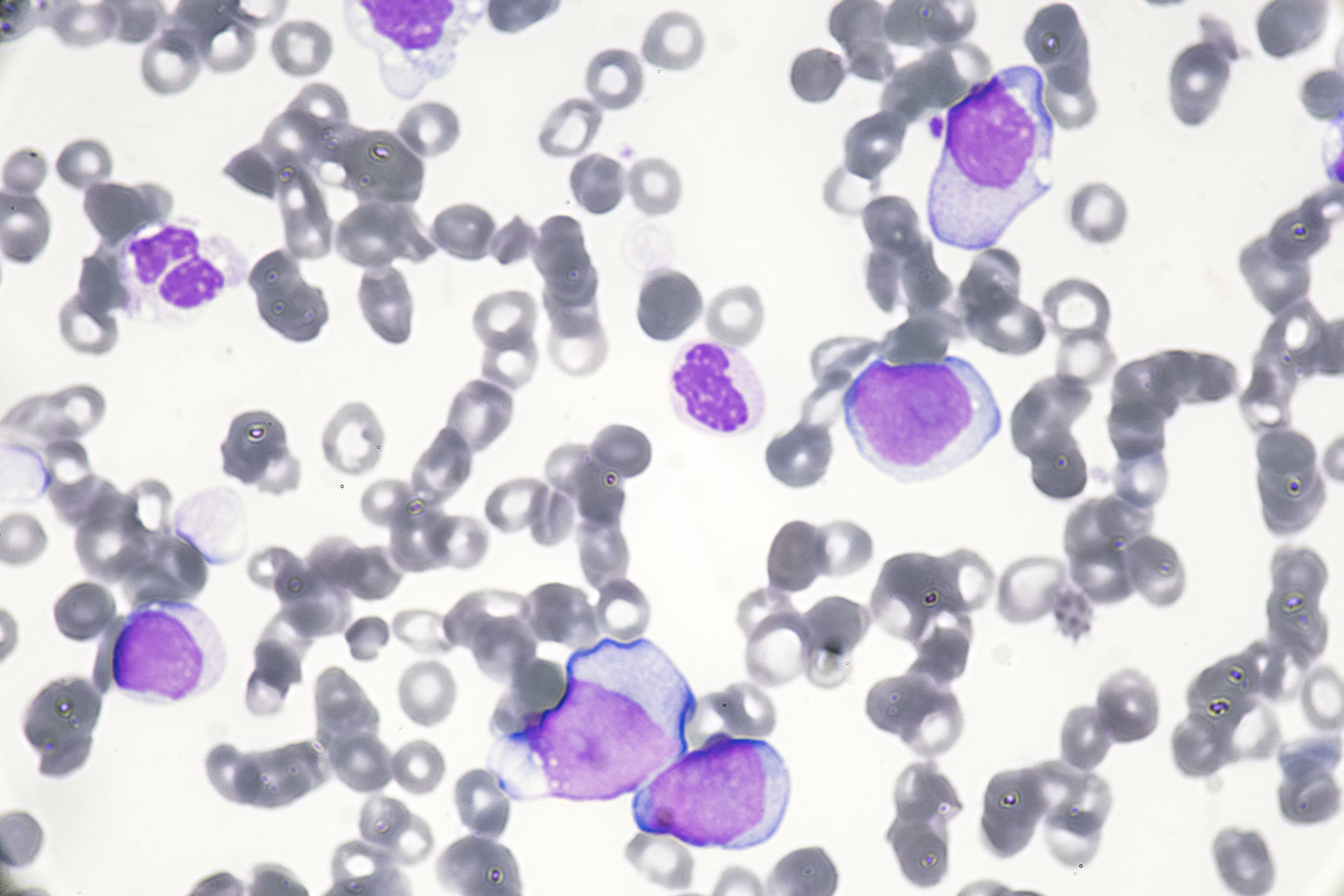 Acute myeloid leukemia -- Image credit: Pichitchai | stock.adobe.com