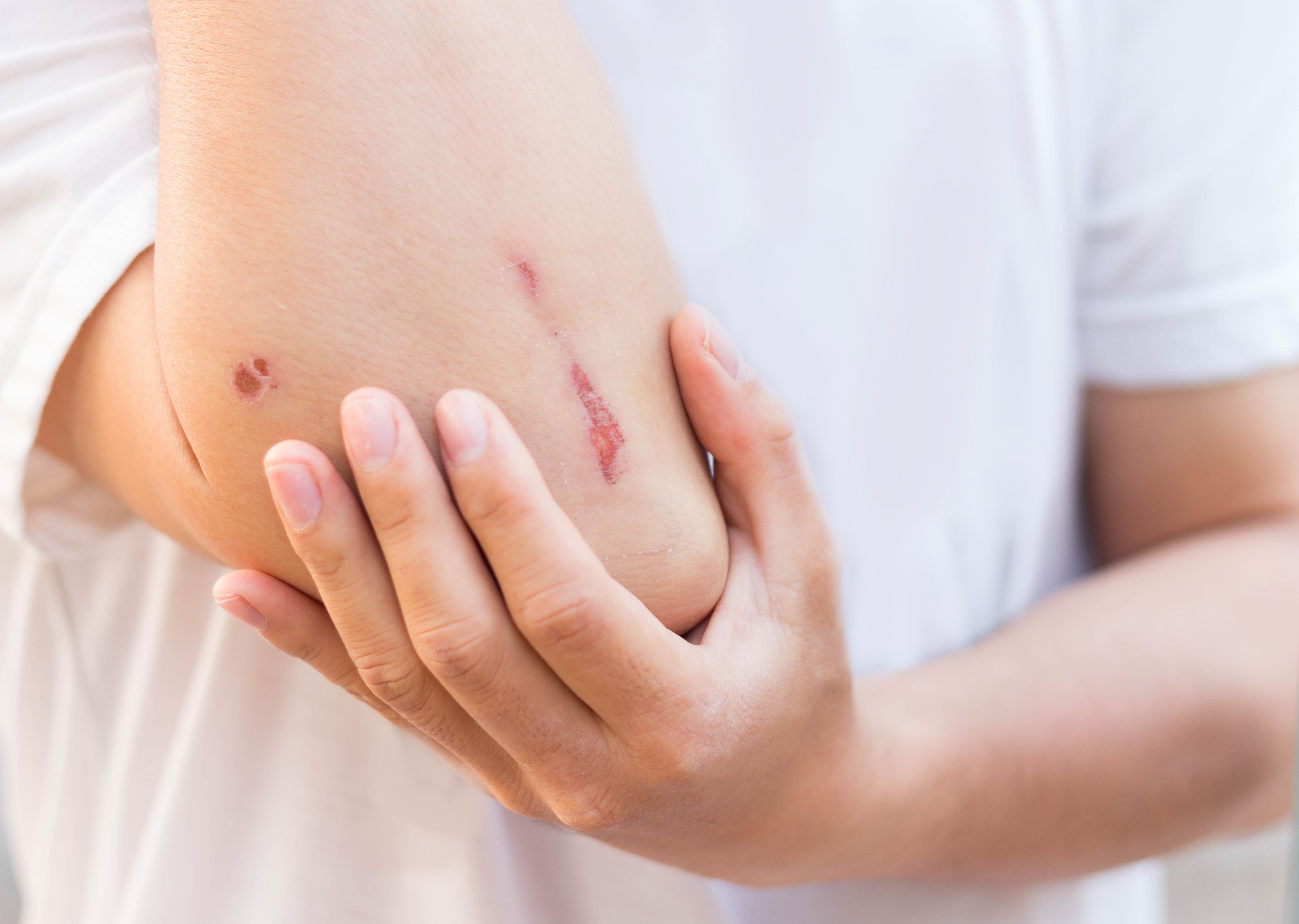 Man show lesion or wound on his arm after accident - Image credit: nespix | stock.adobe.com